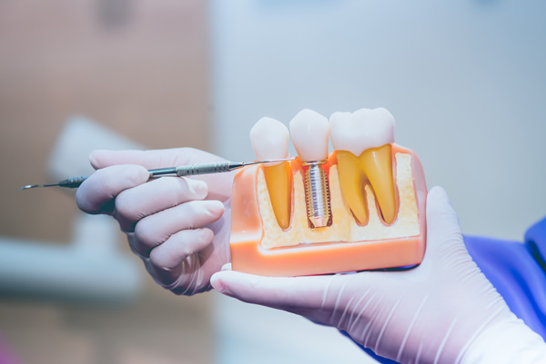 Close up of hands indicating dental implant 3D model