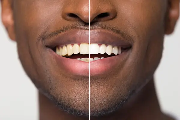 Close up comparison of before and after teeth whitening treatment on a patient's smile